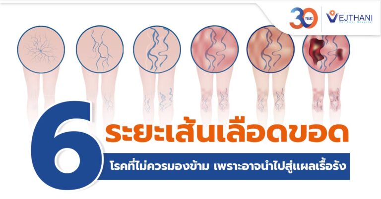 វិធីព្យាបាលនៃ ដំណាក់កាលទាំង ៦​ នៃជំងឺប៉ោងសរសៃវ៉ែន (Varicose)